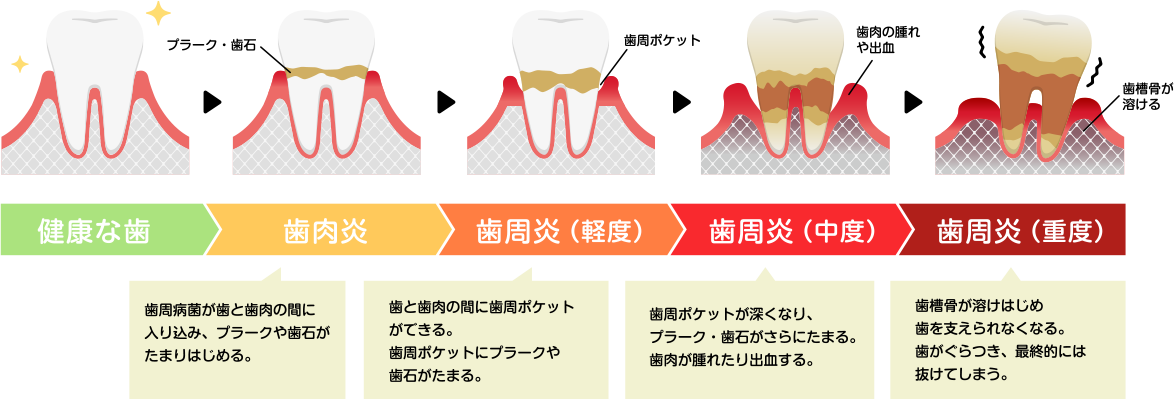 歯肉炎と歯周炎